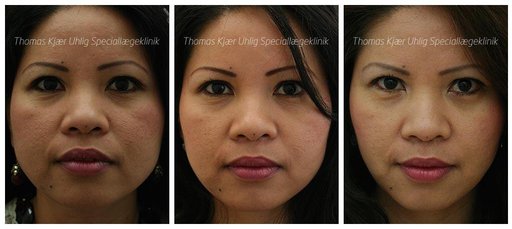 En smallere kæbe efter Botox behandling. Fremhæver kindben. Kvinde før og efter.