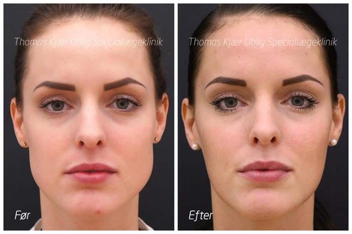 Kvinde før og efter behandling med Botox for reduktion af kæbemuskulaturen. Det ses hvordan kæben virker mindre bred