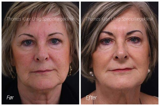 Kvinde før og 5 år efter løft af mundvige med Restylane