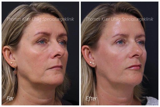 Kvinde før og efter behandling med Botox og Restylane til kindben, mundvige og læber. Bemærk den mere feminine udstråling.