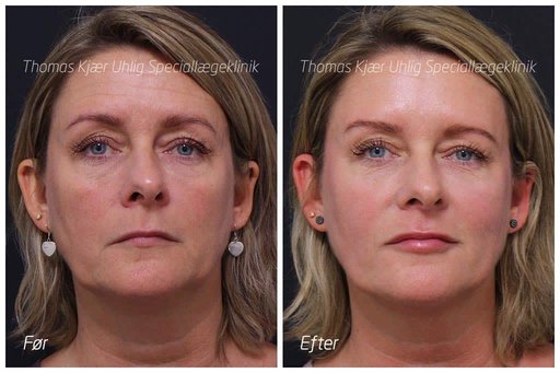 Kvinde før og efter kosmetiske behandlinger med Botox til bekymringsrynke og Restylane til kindben, læber og mundvige. Naturligt og feminint.