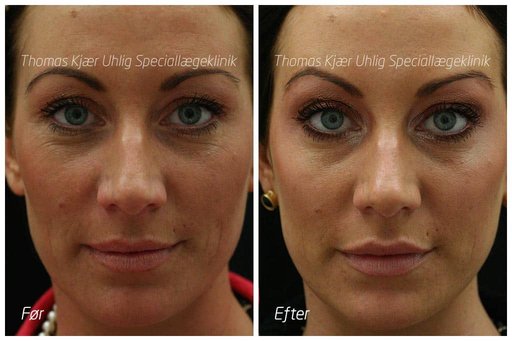 Før og efterbillede af kvinde behandlet med Botox. Der ses hvordan brynene er løftet på efterbilledet.