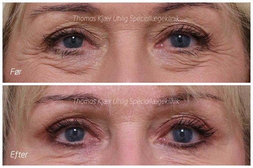 Kvinde før og efter Botox behandling ved øjnene. Brynene er løftet en smule og smilerynker samt rynker under øjnene er mindsket betragteligt.