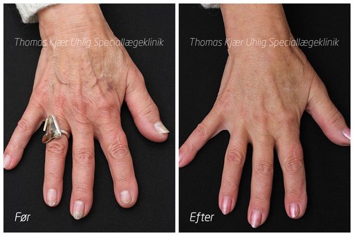 Hånd behandlet med Restylane Skinbooster