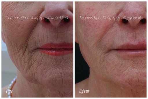 Kvinde før og efter behandling med Restylane Skinbooster. Endvidere er der givet lidt spændstighed til læberne. Der er 5 år mellem billederne og kvinden er 82 år.