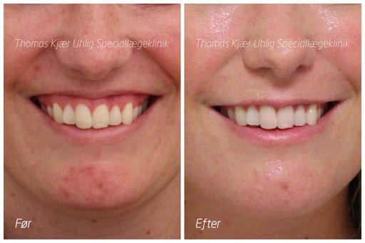 Tandkødssmil mindskes med en Botox behandling. Kvinde før og efter.
