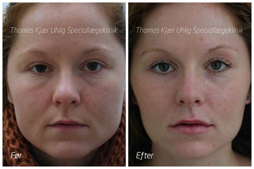 Smallere kæbe med en Botox behandling skaber et mere feminint udtryk. Kvinde før og efter