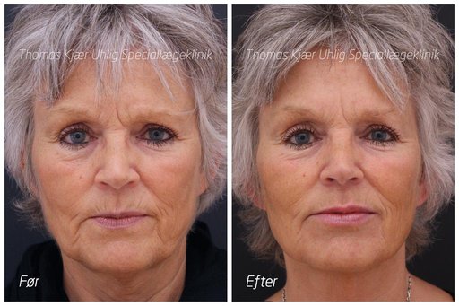Kvinde før og efter en Restylane behandling for nedadgåene mundvige og rynker omkring munden. Et friskere og yngre udseende.