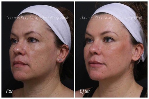 Kvinde før og efter Restylane behandling til kindben, mundvige og læber