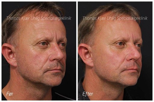 Claus Elgaard før og efter Botox behandling af smilerynker